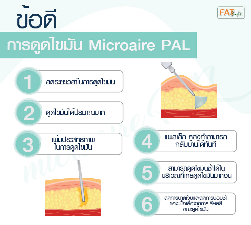 ข้อดีการดูดไขมัน Microaire PAL