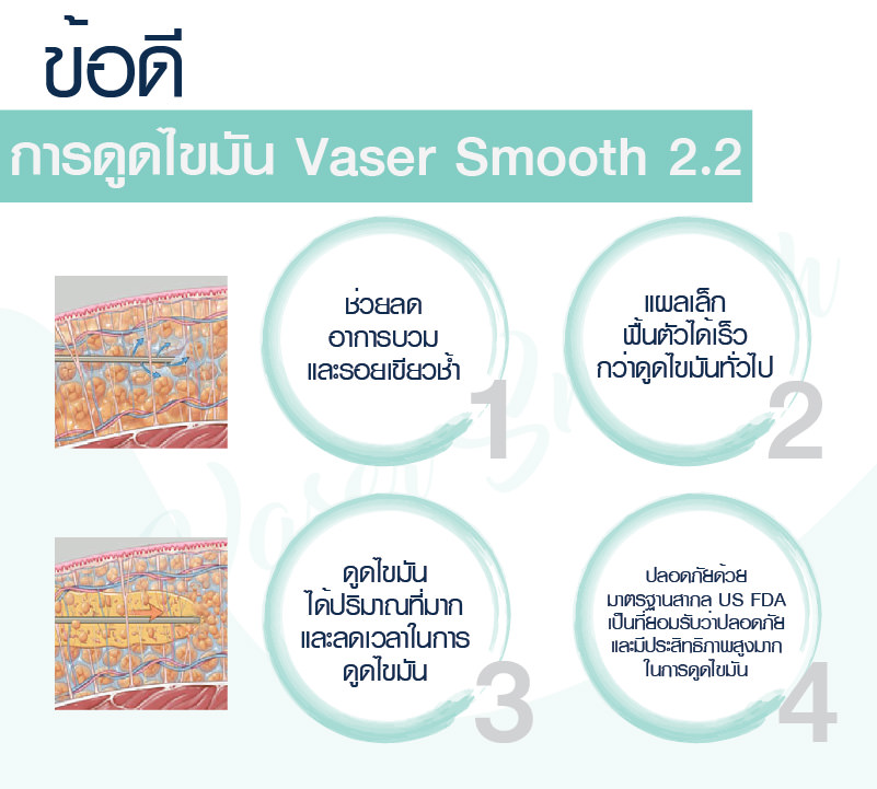 ข้อดีการดูดไขมัน Vaser Smooth 2.2